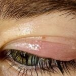 Cosa mettere sulla palpebra gonfia