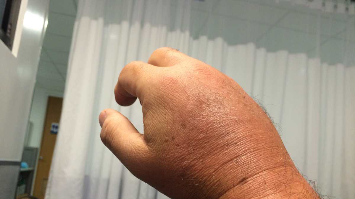 mano gonfia, algodistrofia