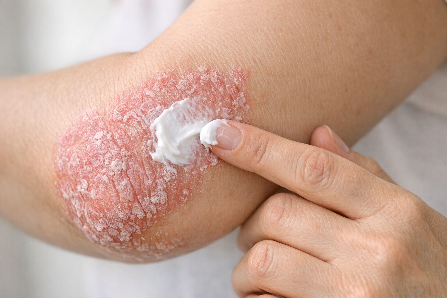 Psoriasi