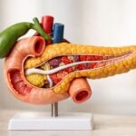 Daraxonrasib nel tumore al pancreas metastatico: perché Max Parisi è andato negli USA e cosa cambia in Italia