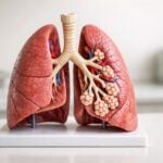 Papa Leone XIV dimesso dopo la lobectomia: cosa sappiamo su adenocarcinoma e prossime cure